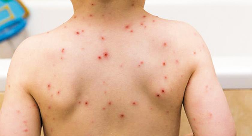 Czy grozi nam epidemia odry?