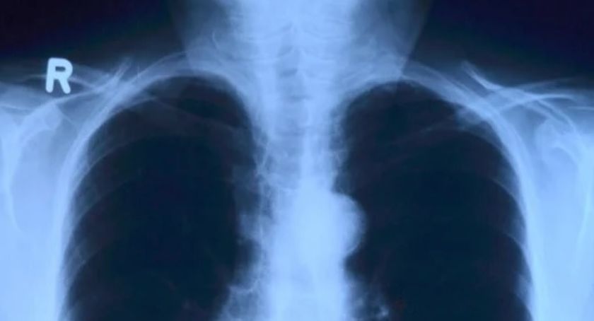 Dodatkowe pieniądze na walkę z Covid-19. Szpital w Szczecinku zakupi aparat RTG 