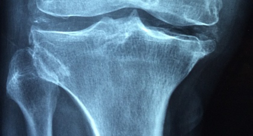 Mieszkańcy Szczecinka badają swoje kości. Komu grozi osteoporoza?
