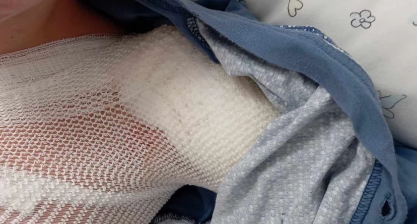 Zbiórka dla Wojtusia z Łomży. Chłopiec ma poparzenie III stopnia