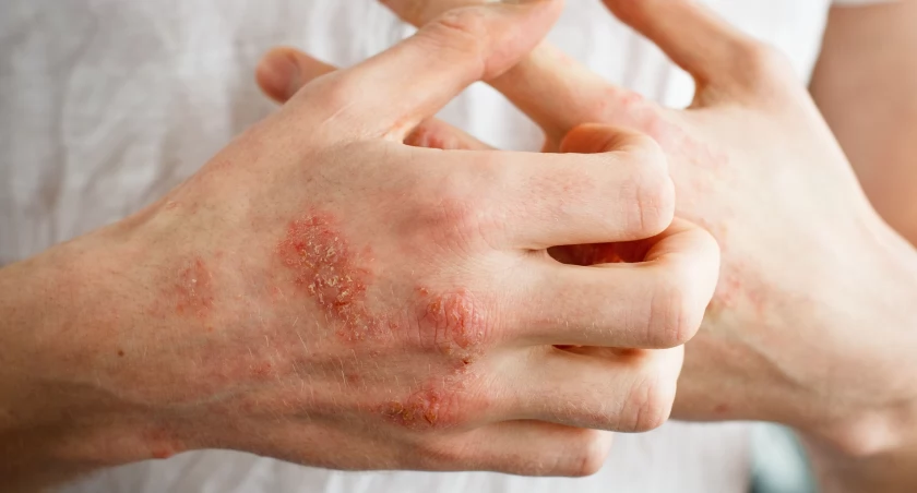 Balsamy na AZS – z polecenia dermatologów
