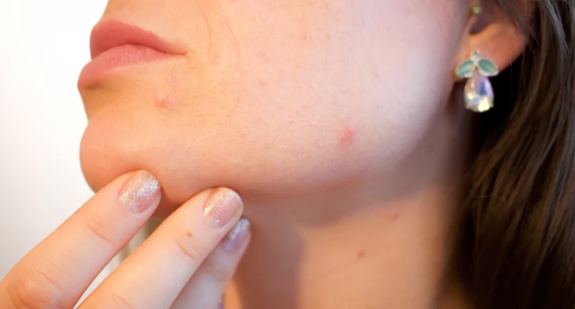 Wszystko, co warto wiedzieć o trądziku hormonalnym