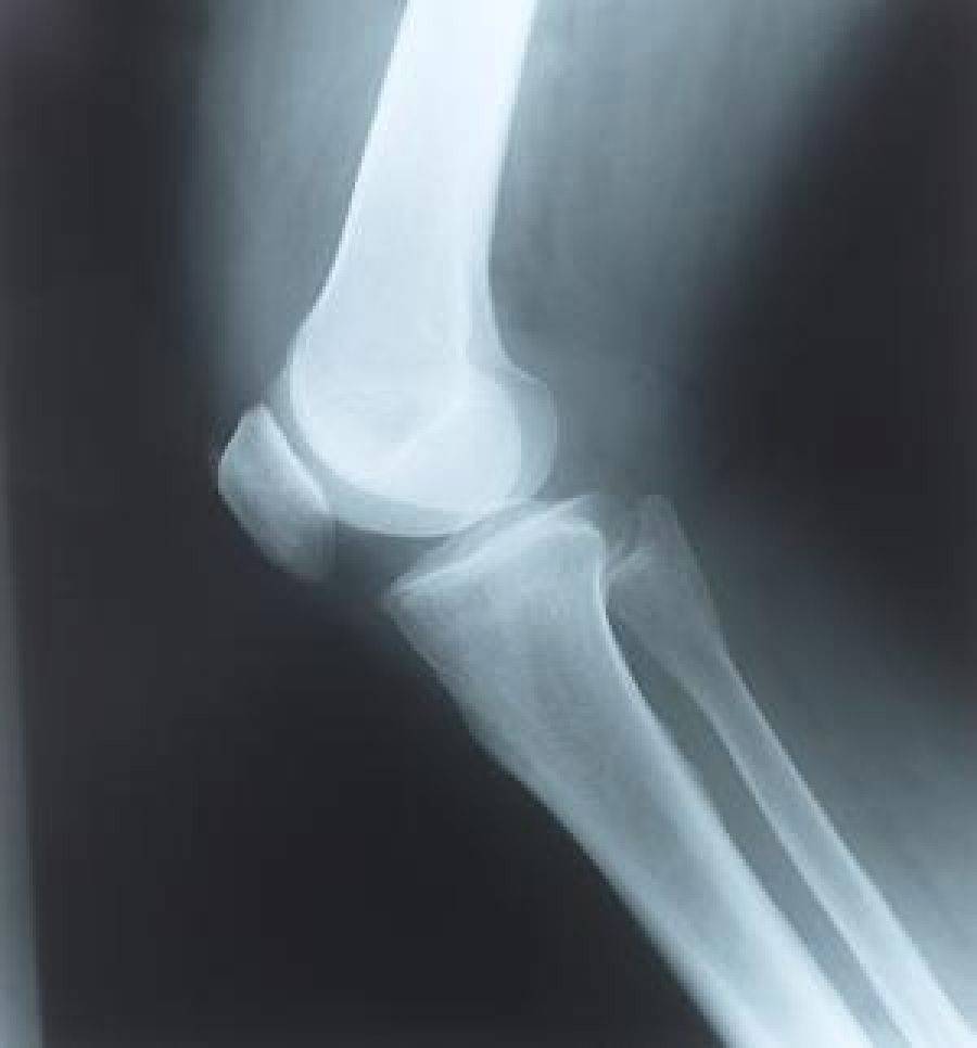 Osteoporozę wyleczysz w Łomży