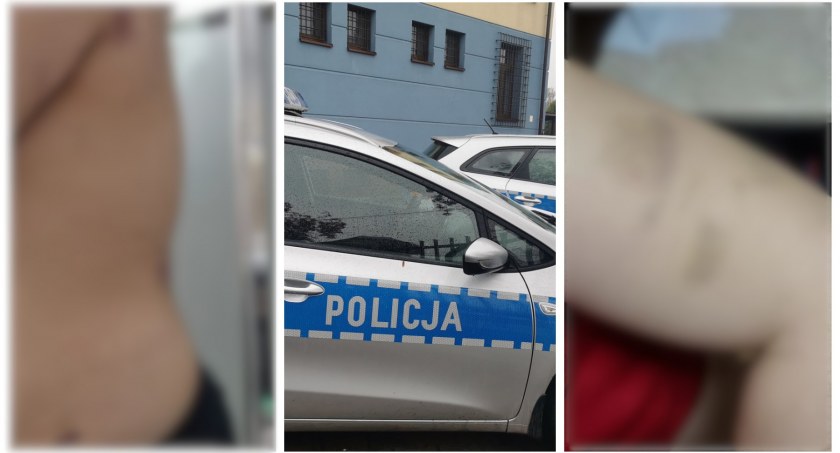 Partner bił ją po całym ciele – Kobieta boi się, bo wyszedł na wolność