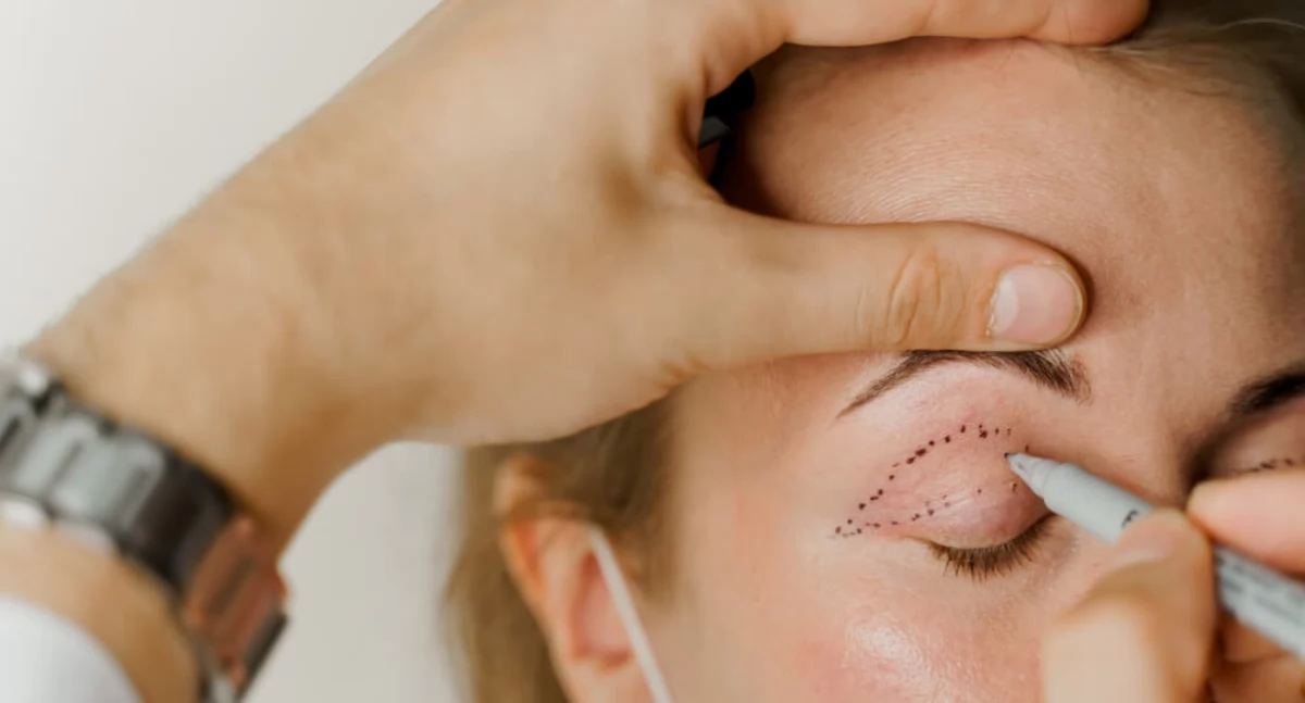 Blefaroplastyka – odpowiedzi na najczęstsze pytania o zabieg