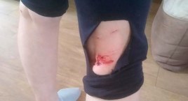 Rany szarpane, ugryzienia oraz liczne siniaki. To efekt ataku pięciu mieszańców psów myśliwskich na mieszkankę Sylczna