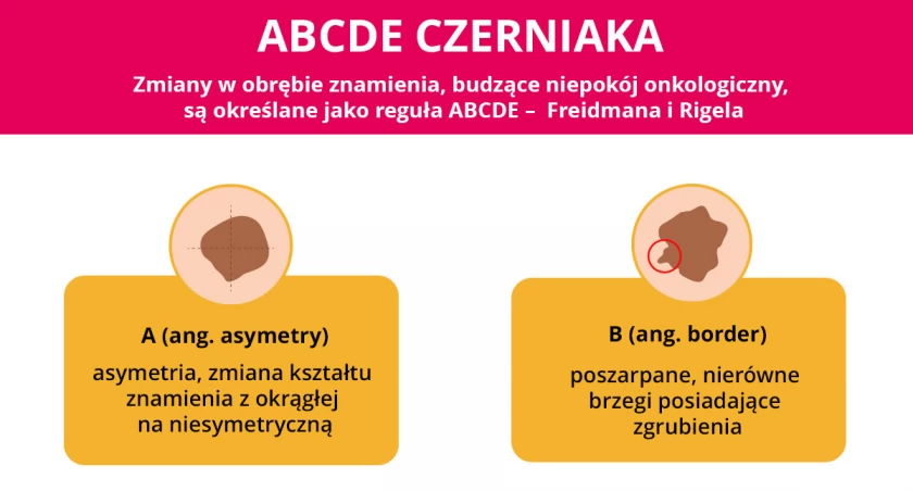 Profilaktyka czerniaka. Te badania zrobisz na NFZ
