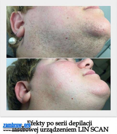 Powiększamy piersi – bez narkozy i długiej rekonwalescencji – w Zambrowie!