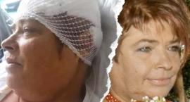 Jola Kolus przeszła operację mózgu 