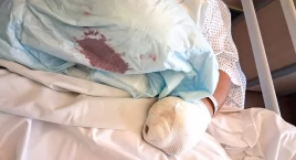Petarda rozerwała dłoń, urwała palce. Ułamki sekund zmieniły życie