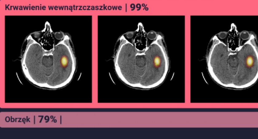 Sztuczna inteligencja w diagnostce uszkodzeń mózgu. Testy w nyskim szpitalu 