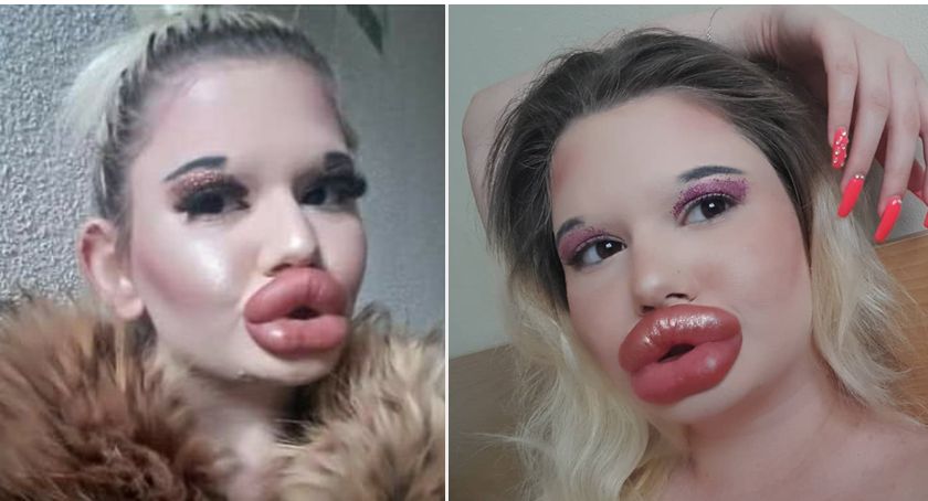 Żywa Barbie chce jeszcze bardziej powiększyć usta. Lekarz ostrzegł ją przed śmiercią!