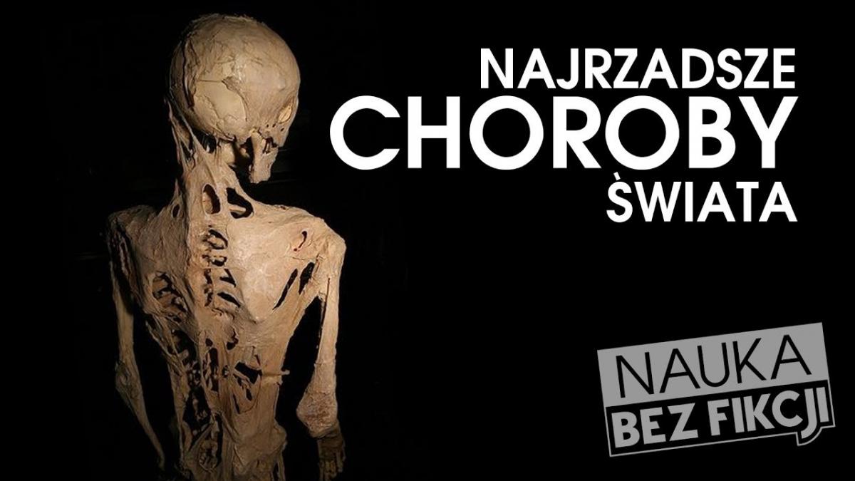 Najrzadsze choroby, które dotknęły tylko kilkoro ludzi na świecie! SPRAWDŹ