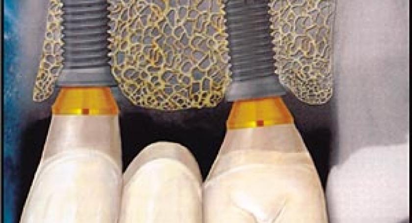 Implanty dentystyczne – terapia naśladująca naturę