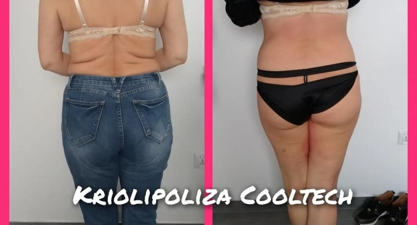 Pozbądź się opornej tkanki tłuszczowej w Nowym Roku. Zapisz się teraz i otrzymaj 2 zabiegi GRATIS