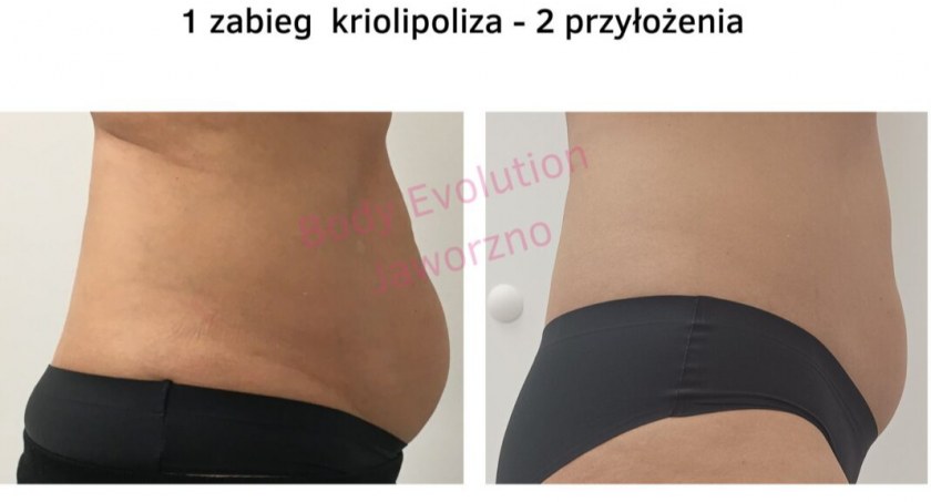 Czy istnieje zabieg, który bezboleśnie i szybko zredukuje obwody ciała?