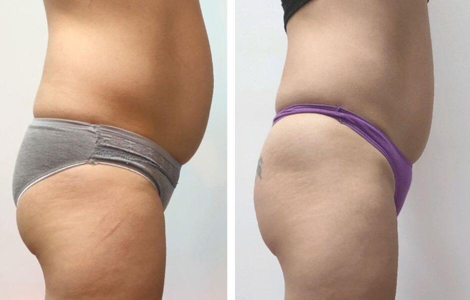 Redukcja tkanki tłuszczowej na lata z Body Evolution