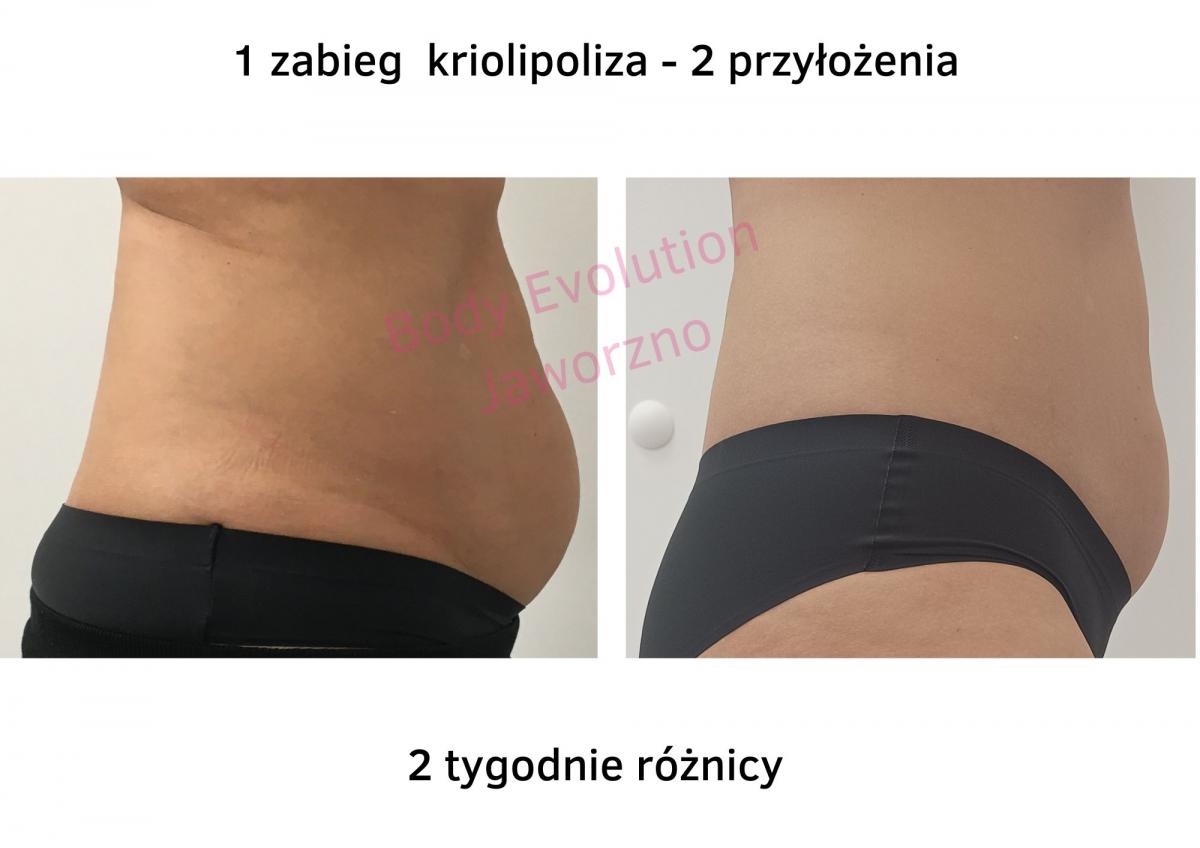 Czy istnieje zabieg, który bezboleśnie i szybko zredukuje obwody ciała?