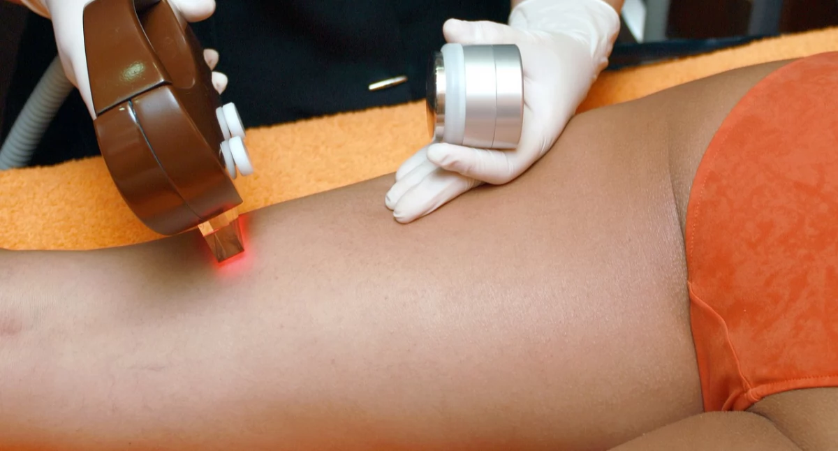 Aparat do laseroterapii jako skuteczny sposób na usunięcie przebarwień