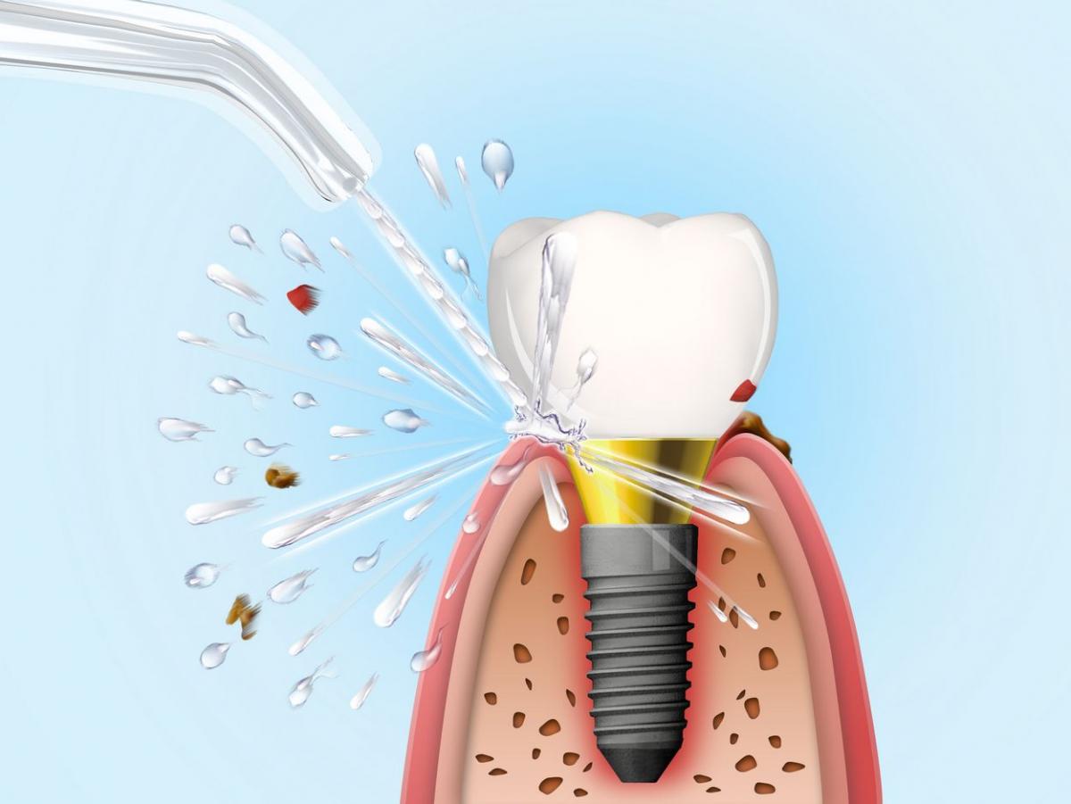 Wybór odpowiedniego irygatora dentystycznego