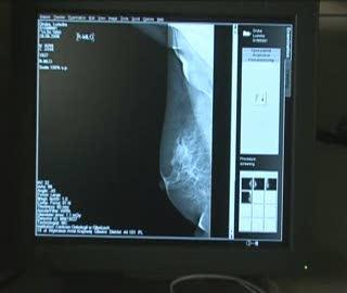 Bezpłatna mammografia