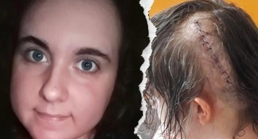 Agnieszka ma 27 lat i złośliwego guza w mózgu - pilnie potrzebuje operacji i pomocy