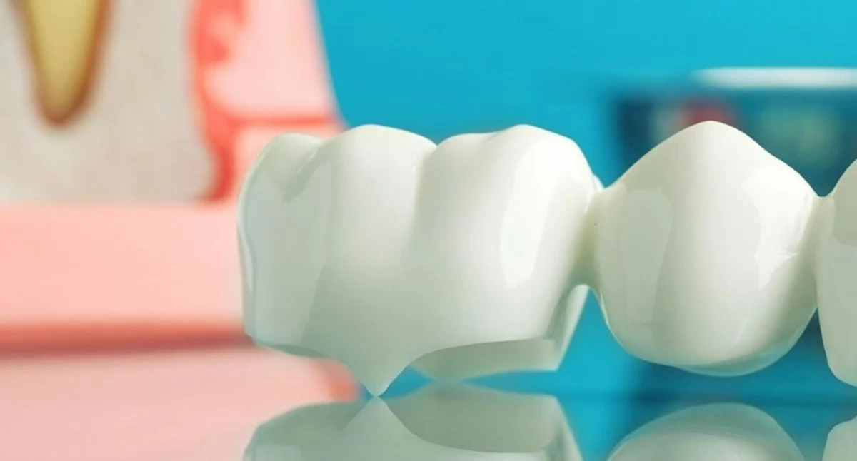 Mosty porcelanowe. W jakim wypadku mogą Ci pomóc?