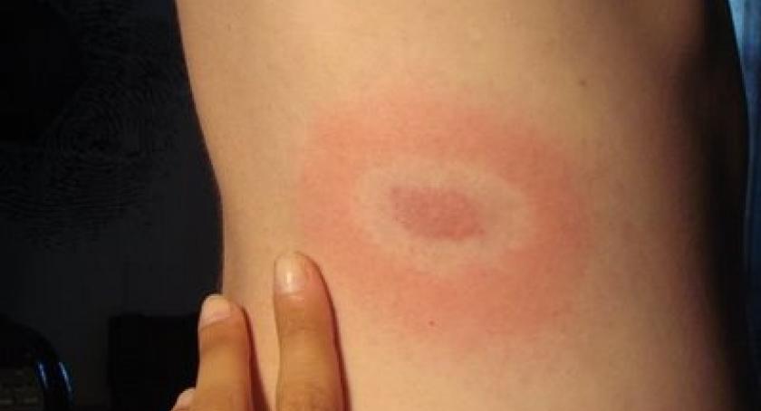 Wzrost zachorowań na boreliozę. Już osiemdziesiąt przypadków w powiecie