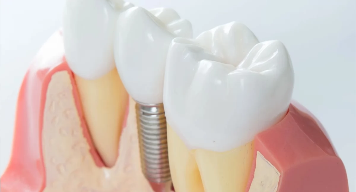 Czy implanty zębowe są bezpieczne – rozwiewamy wątpliwości razem ze specjalistami Dentify