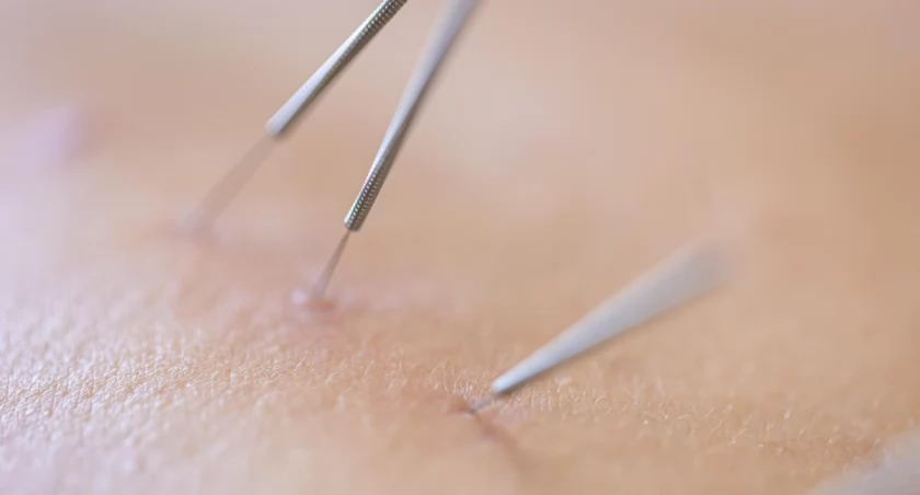 Endermologia LPG - czym się różni od tradycyjnej endermologii?