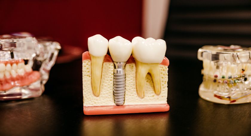 Kiedy po wyrwaniu zęba można wstawić implant
