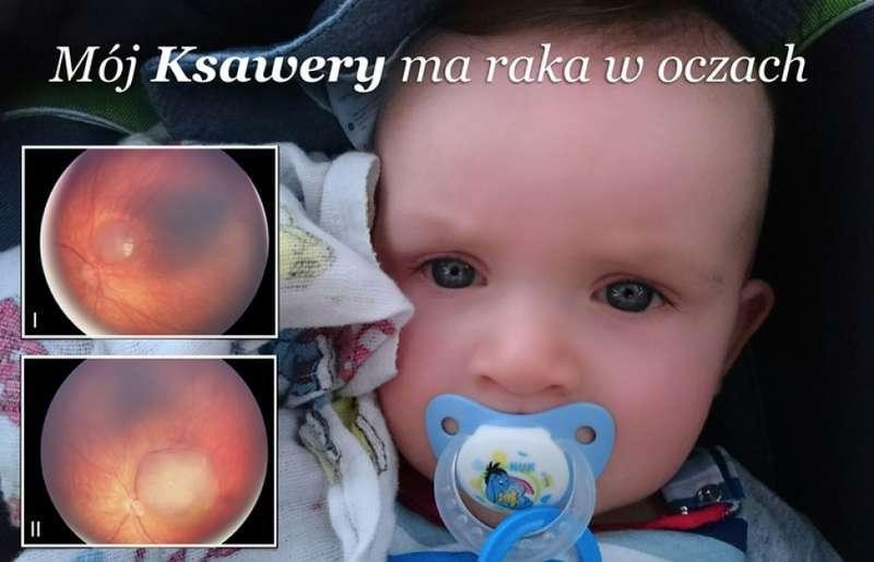 Ksawery ma zaledwie rok. Rak zaatakował jego oczy