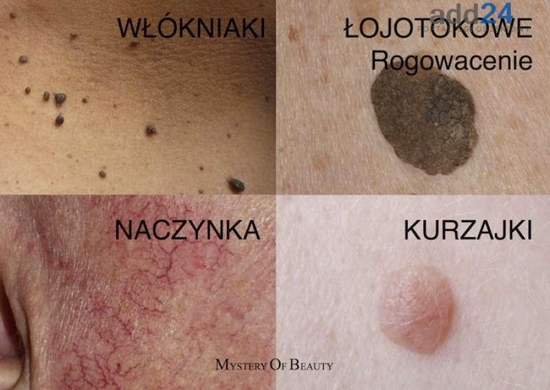 Koszmar pękających naczynek – czy jest szansa by się ich pozbyć ?
