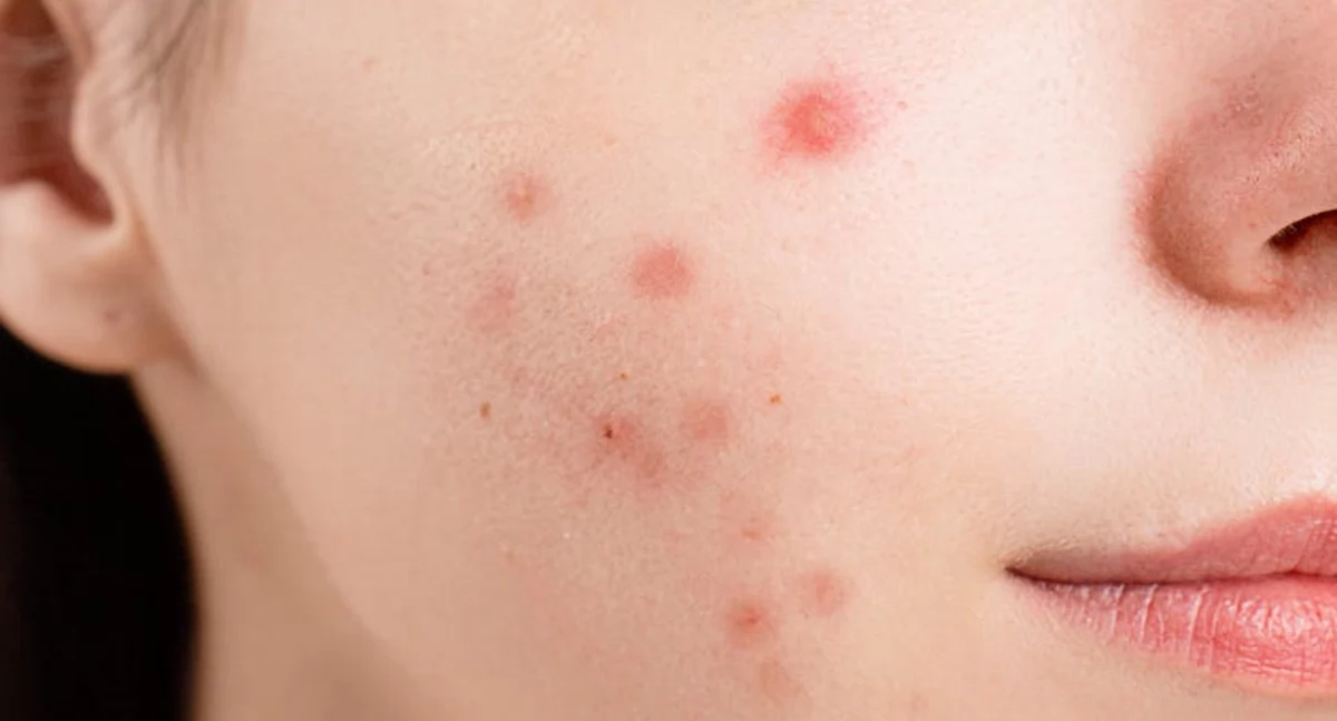 Jakie objawy mogą świadczyć o zaburzeniach hormonalnych?