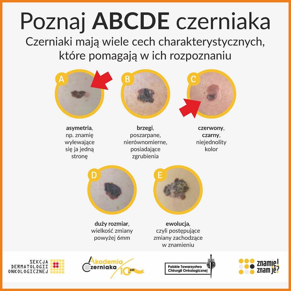 Program profilaktyki czerniaka w kamiennogórskich szkołach