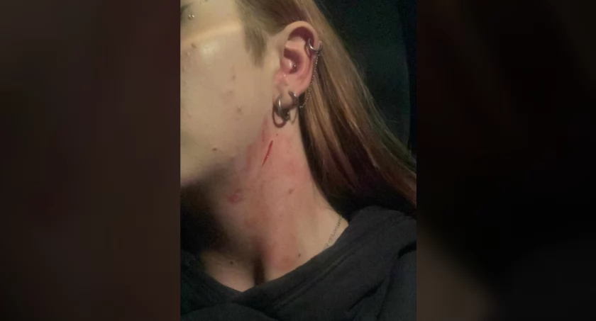 19-latka brutalnie zaatakowana w Nowym Targu - poszukiwany napastnik