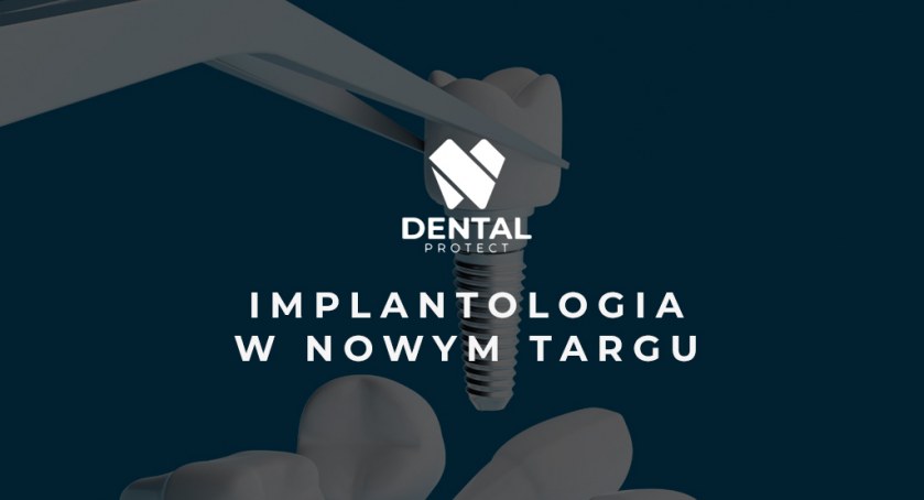 Implanty stomatologiczne