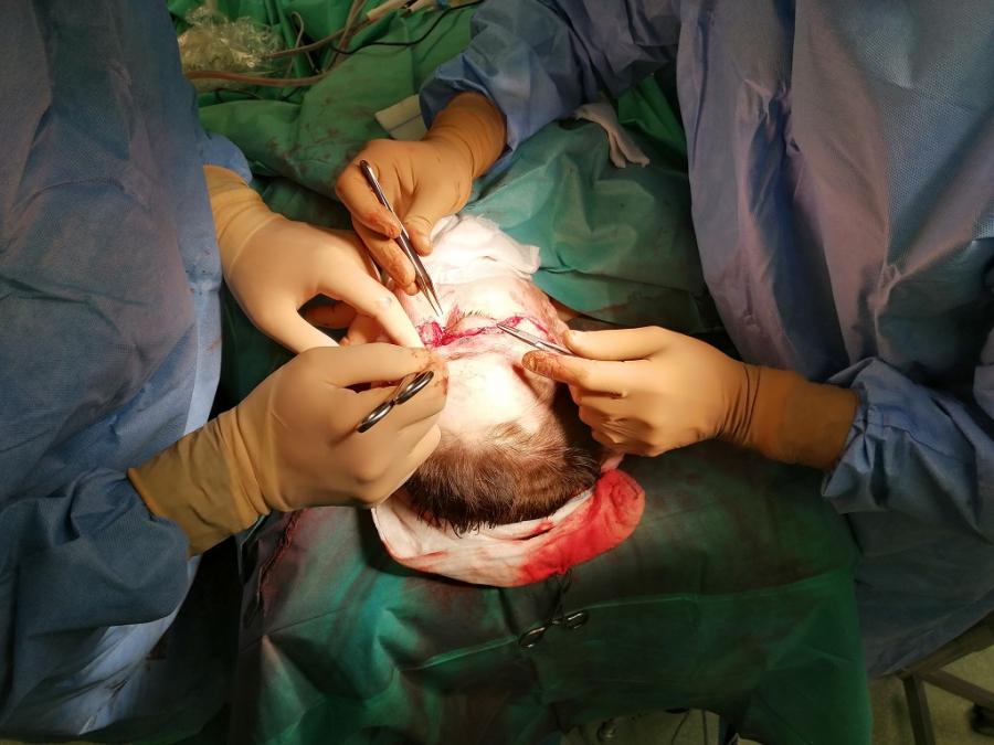 Maszyna zerwała pracownicy strefy skalp. Lekarze dokonali retransplantacji