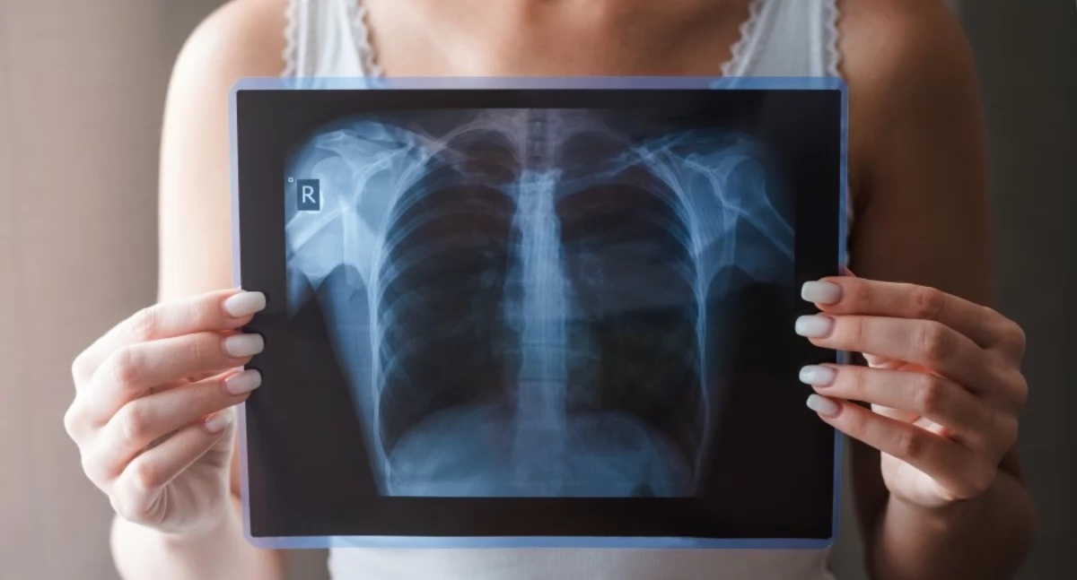 Dbaj o zdrowie płuc- skorzystaj z bezpłatnej tomografii w Białej Podlaskiej!