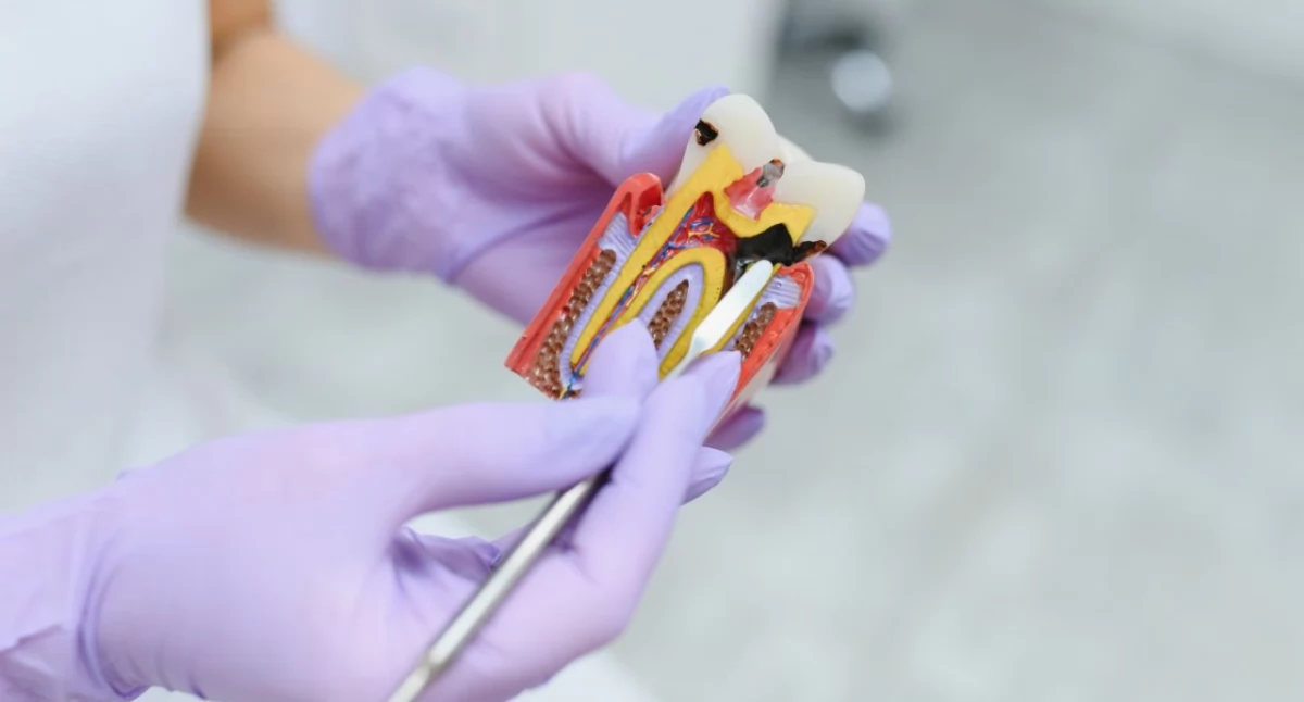 Czym jest endodoncja i kiedy jest konieczna?