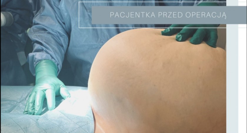 10 kg mięśniak macicy. Pacjentka myślała, że 