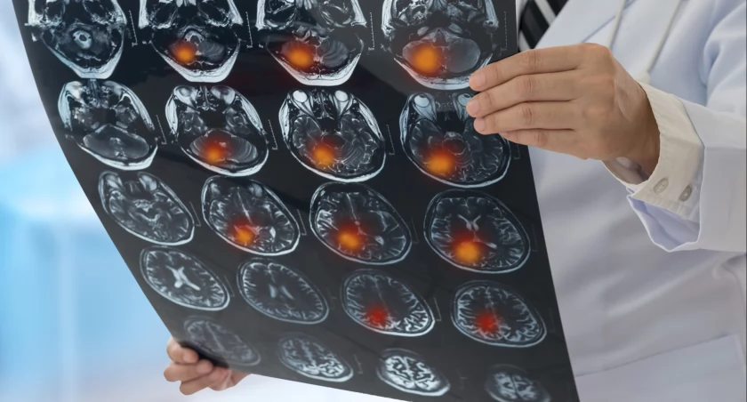 Pilotaż leczenia udarów za pomocą trombektomii mechanicznej ponownie wydłużony 