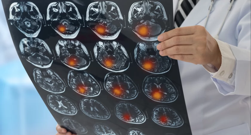 Szpital kliniczny w Lublinie zakupił aparaturę do neurochirurgii za 12,5 mln zł