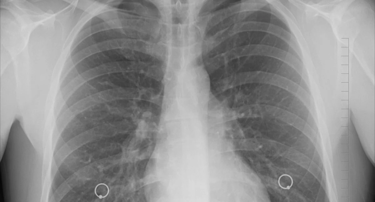  Eksperci: Rak płuca wciąż późno wykrywany. „Przebieg kliniczny jest bardzo podstępny”