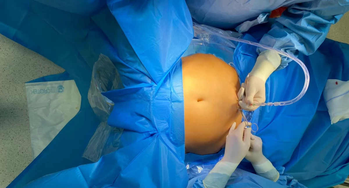 Unikalna operacja urologiczna w Polsce – zabieg wykonano w wejherowskim szpitalu