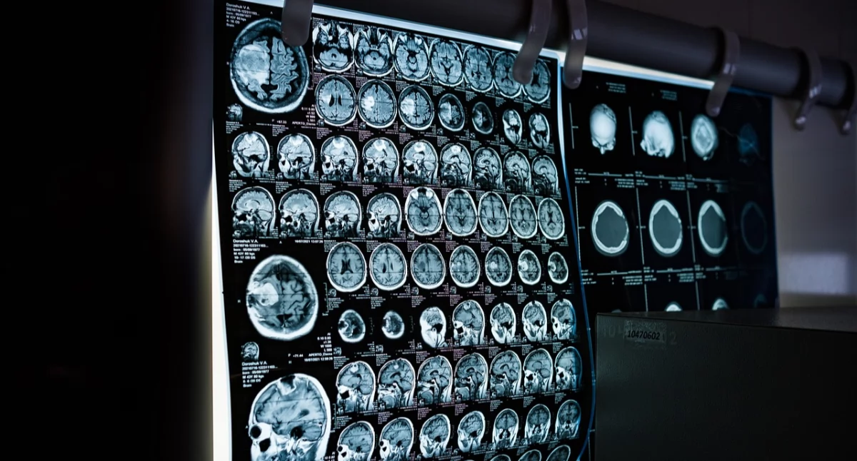 Aż 60 proc. pacjentów z chorobami sierocymi nie dostaje prawidłowej diagnozy