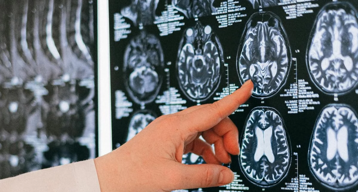 Postępy w leczeniu stwardnienia rozsianego – już jutro konferencja neurologiczna w Łodzi
