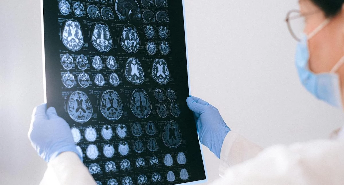 Nowa technologia MRI umożliwia przełomową operację pacjentom z padaczką 