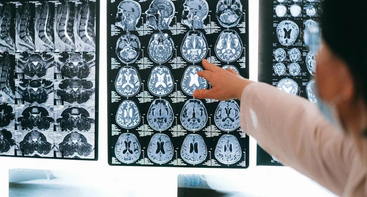 W Polsce aż 370 tys. osób cierpi na epilepsję. Choroba może wywoływać silny lęk