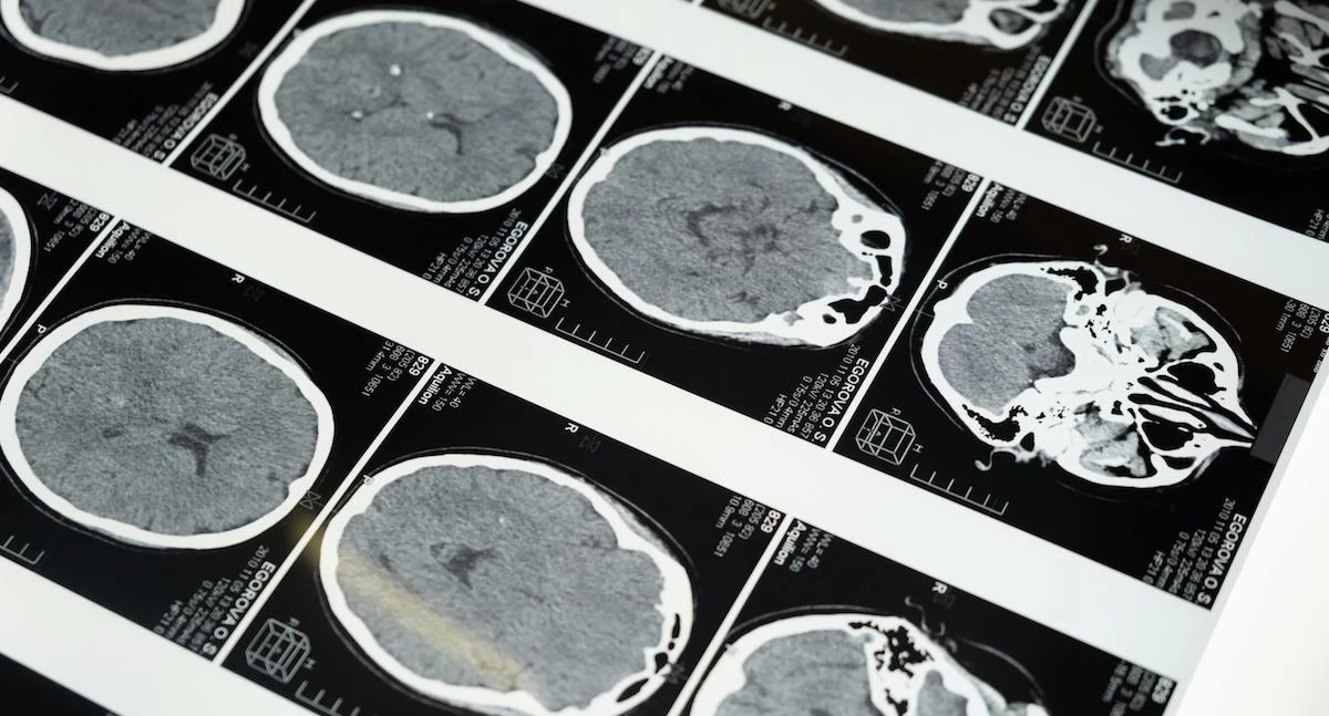 Starzejący się mózg może zwiastować schizofrenię. Naukowcy odkryli biomarker